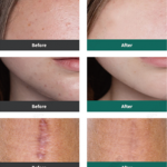 экзосомы до и после