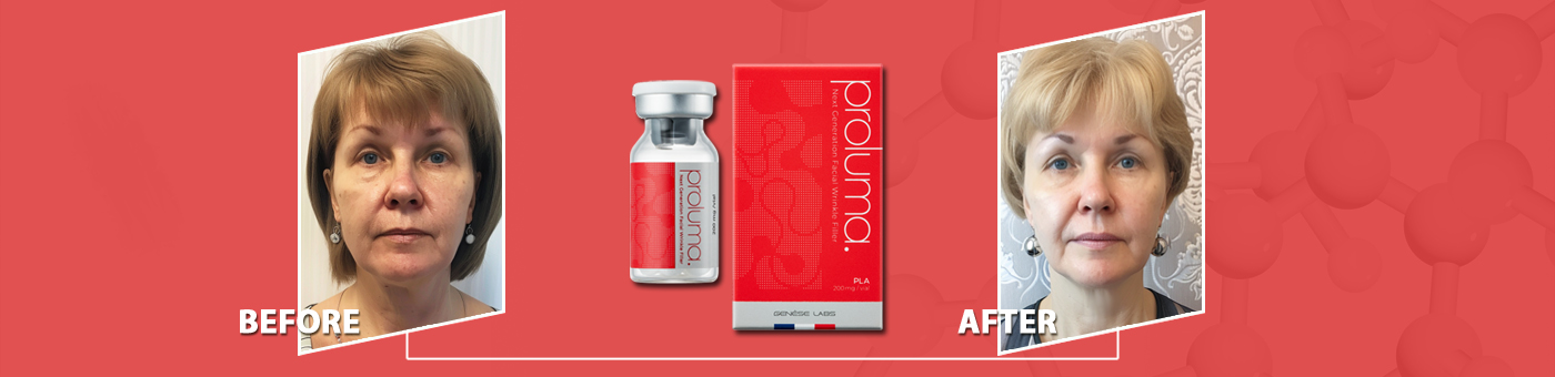 Proluma PDLLA до и после