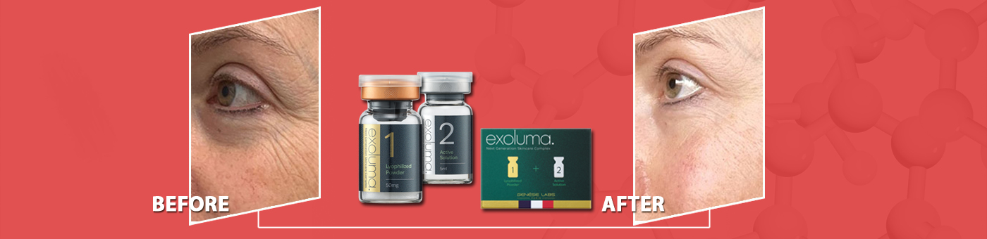 bio exoluma до и после