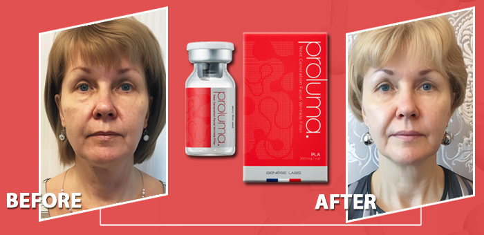 proluma до и после